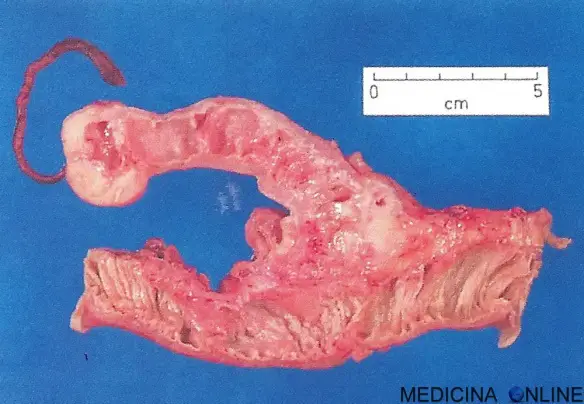 MEDICINA ONLINE CAMPIONE CHIRURGICO DIVERTICOLO DI MECKEL INTESTINO CHIRURGIA.jpg