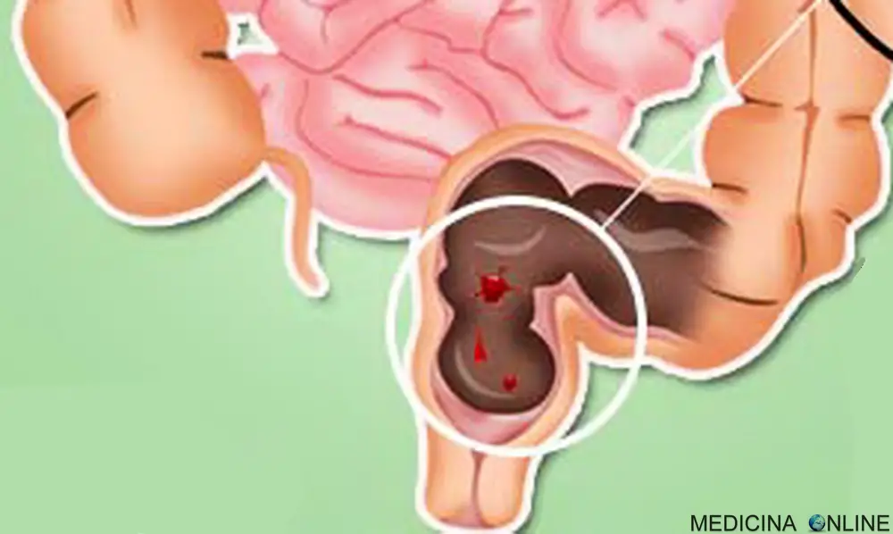 MEDICINA ONLINE EMATOCHEZIA INTESTINO COLON TENUE DUODENO DIGERENTE ANATOMIA RETTORRAGIA BRUCIORE DOLORE DIGESTIONE FECI STIPSI COSTIPAZIONE PANCIA GONFIA STITICHEZZA FIBRE METEORISMO FLATULENZA GAS