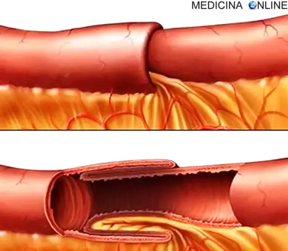 MEDICINA ONLINE Intussuscezione intestinale (invaginazione) significato, sintomi, terapia in bambini e adulti