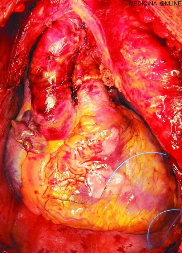 MEDICINA ONLINE CUORE TRAPIANTATO MIOCARDIO TRAPIANTO DI CUORE VASI AORTA SANGUE MIOCARDIO BYPASS MACCHINA MACCHINARIO TEMPERATURA