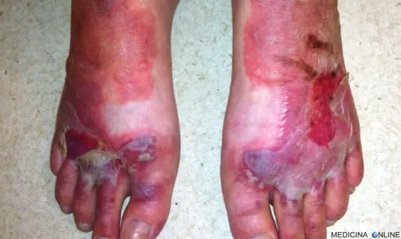 MEDICINA ONLINE PELLAGRA PELLE CUTE DERMA DESQUAMAZIONE TIAMINA PIEDI DITA INFEZIONE INFIAMMAZIONE DIETA CIBO COSE SIGNIFICATO SUBLINICA PATATE CUCINARE ITALIA STORIA SCORBUTO DIARREA.jpg