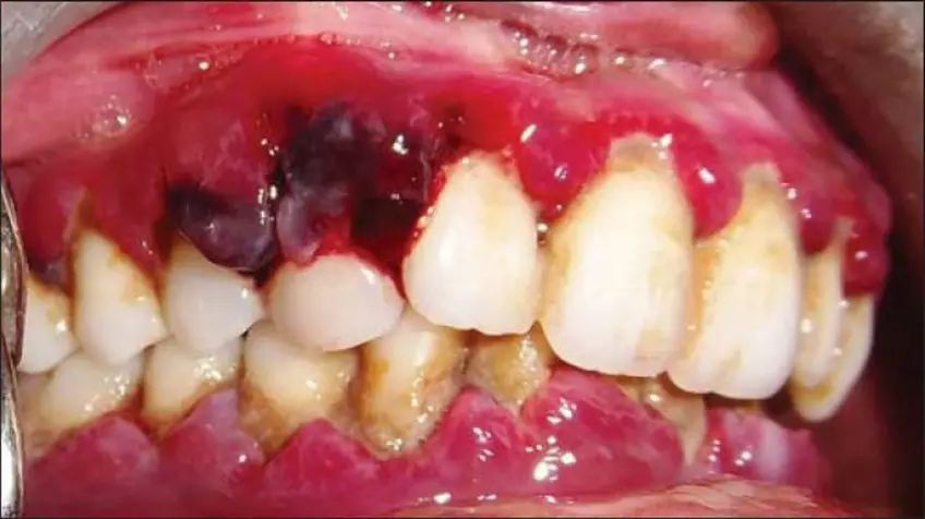 MEDICINA ONLINE SCORBUTO SCURVY IMMAGINE