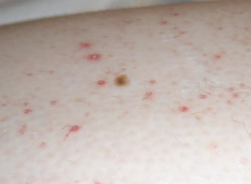 MEDICINA ONLINE SCORBUTO SCURVY IMMAGINE