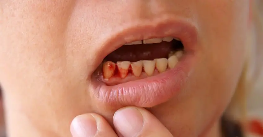 MEDICINA ONLINE SCORBUTO SCURVY IMMAGINE