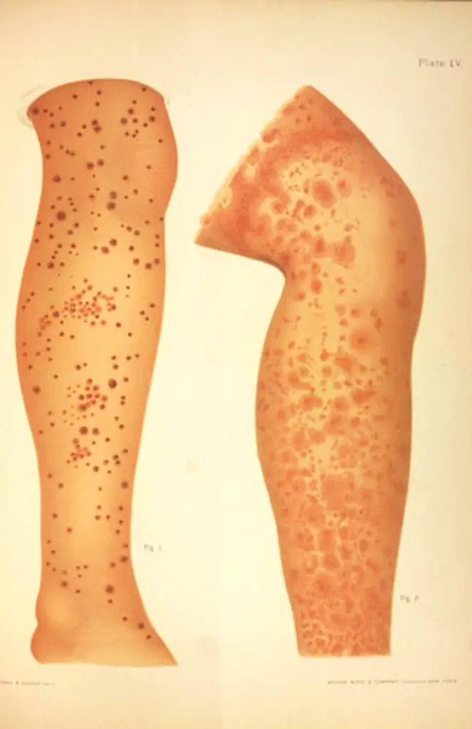 MEDICINA ONLINE SCORBUTO SCURVY IMMAGINE