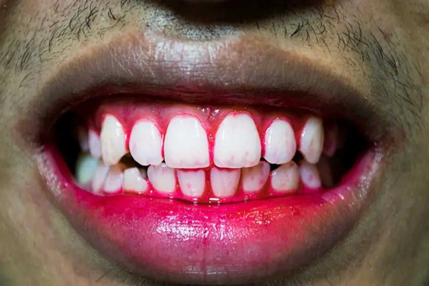 MEDICINA ONLINE SCORBUTO SCURVY IMMAGINE