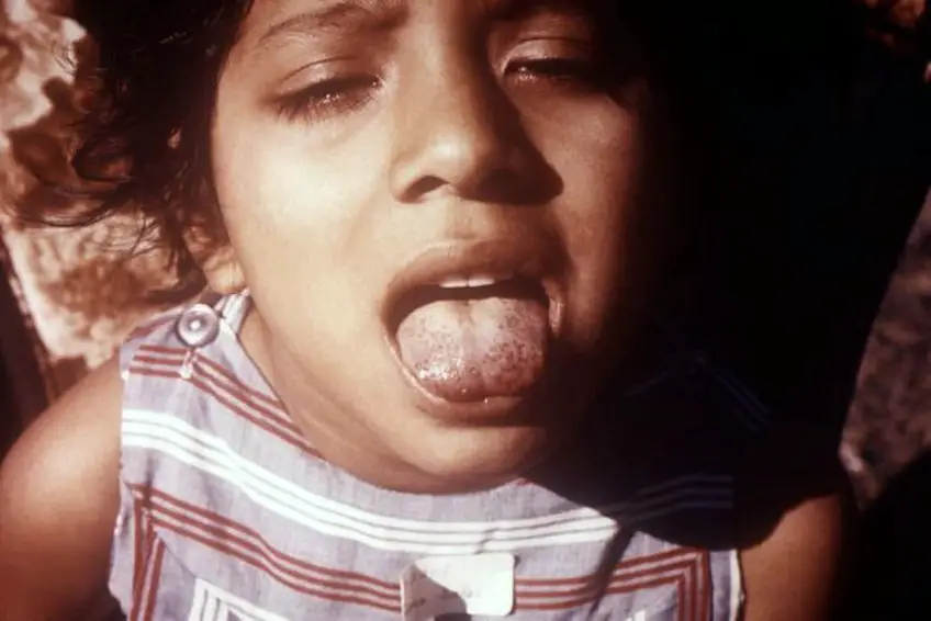 MEDICINA ONLINE SCORBUTO SCURVY IMMAGINE