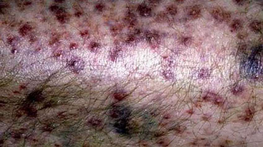 MEDICINA ONLINE SCORBUTO SCURVY IMMAGINE