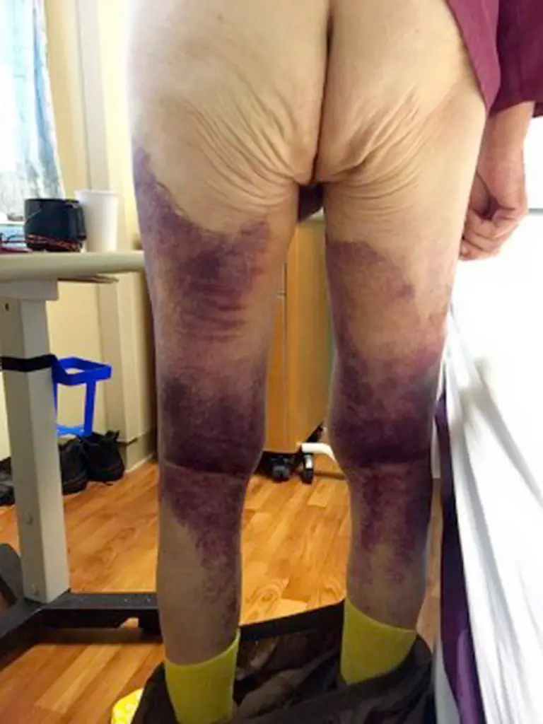 MEDICINA ONLINE SCORBUTO SCURVY IMMAGINE