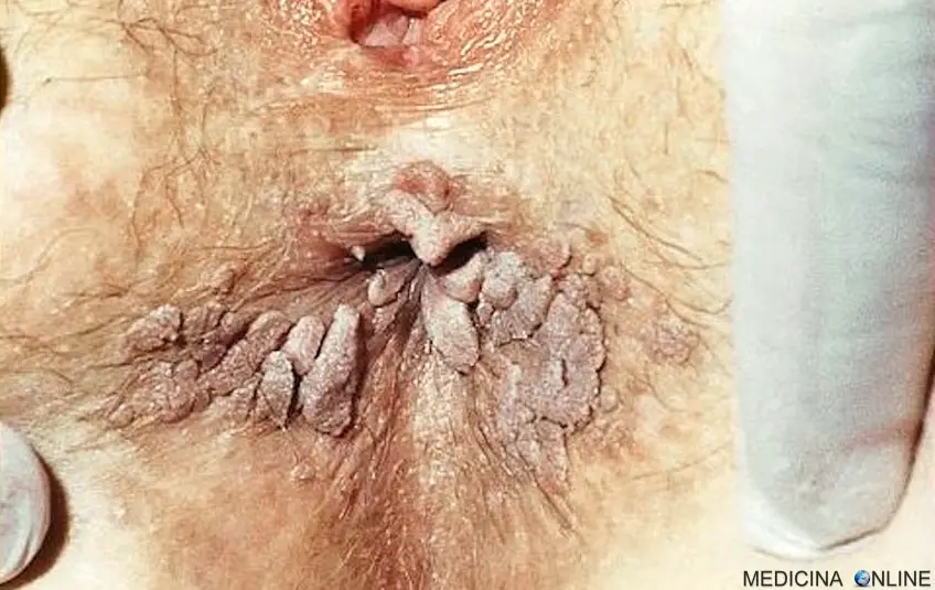 MEDICINA ONLINE CONDILOMA ACUMINATO VERRUCA GENITALE IMMAGINE 1