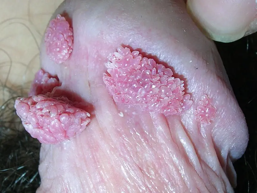 MEDICINA ONLINE CONDILOMA ACUMINATO VERRUCA GENITALE IMMAGINE