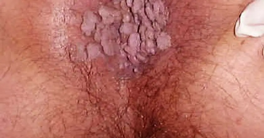 MEDICINA ONLINE CONDILOMA ACUMINATO VERRUCA GENITALE IMMAGINE