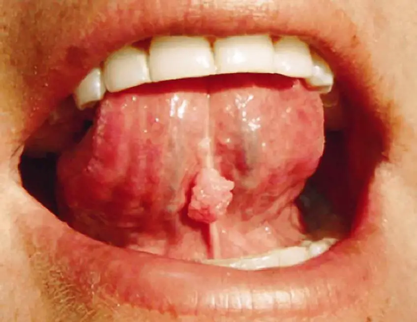 MEDICINA ONLINE CONDILOMA ACUMINATO VERRUCA GENITALE IMMAGINE