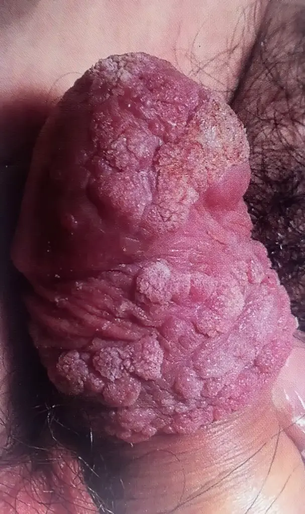 MEDICINA ONLINE CONDILOMA ACUMINATO VERRUCA GENITALE IMMAGINE