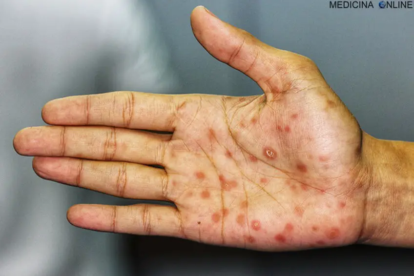 MEDICINA ONLINE SIFILIDE IMMAGINI