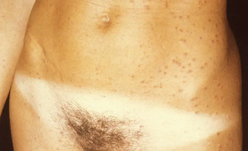 MEDICINA ONLINE SIFILIDE IMMAGINI