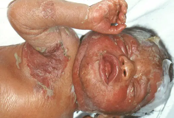 MEDICINA ONLINE SIFILIDE IMMAGINI