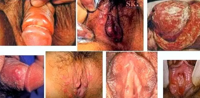 MEDICINA ONLINE SIFILIDE IMMAGINI