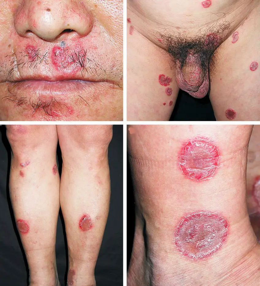 MEDICINA ONLINE SIFILIDE IMMAGINI