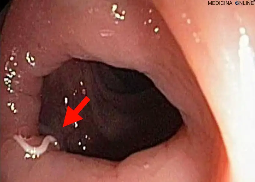 MEDICINA ONLINE OSSIURI VERMI INTESTINALI IMMAGINE