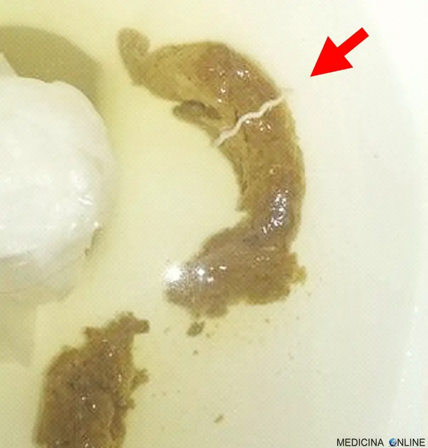 MEDICINA ONLINE OSSIURI VERMI INTESTINALI IMMAGINE