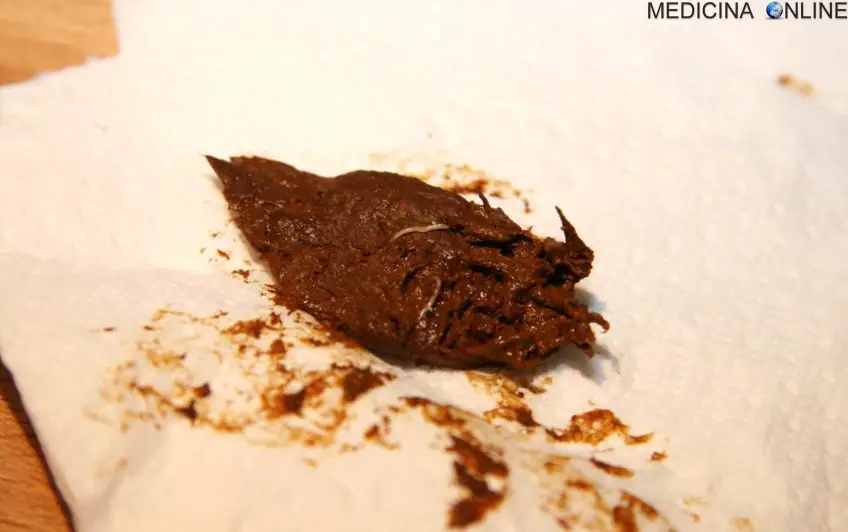 MEDICINA ONLINE OSSIURI VERMI INTESTINALI IMMAGINE