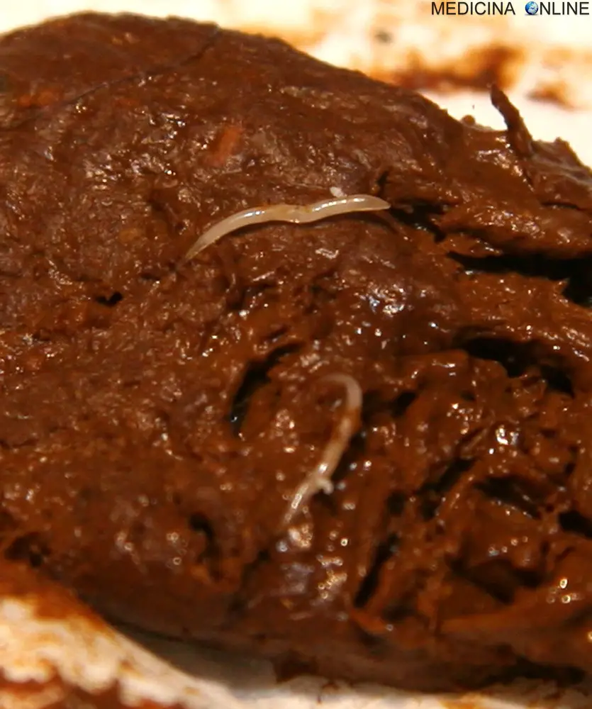 MEDICINA ONLINE OSSIURI VERMI INTESTINALI IMMAGINE