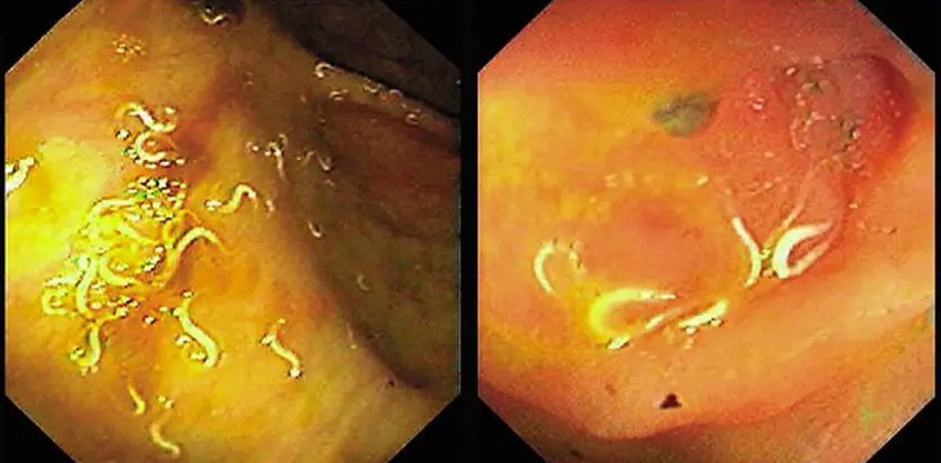 MEDICINA ONLINE OSSIURI VERMI INTESTINALI IMMAGINE