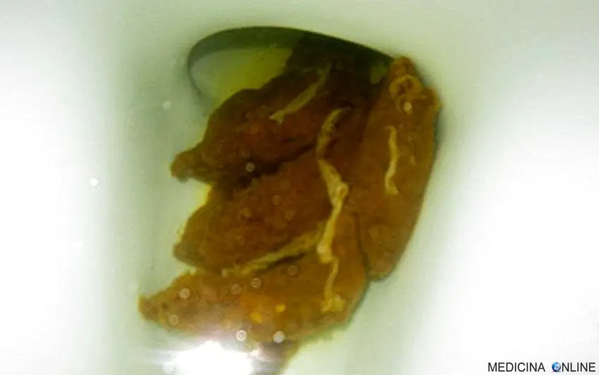 MEDICINA ONLINE OSSIURI VERMI INTESTINALI IMMAGINE