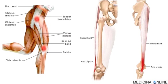 MEDICINA ONLINE SINDROME DELLA BANDELLETTA ILEOTIBIALE GINOCCHIO FIANCO DOLORE GINOCCHIO DEL CORRIDORE RUNNER DIAGNOSI ARTICOLAZIONE CURE RIMEDI CORSA MARATONA NUOTO SPORT RIPOSO GAMBA COSCIA.jpg