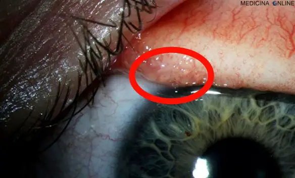 MEDICINA ONLINE ABBY BECKLEY Thelazia gulosa Una donna si è ritrovata nell'occhio 14 vermi vivi di un centimetro l'uno parassiti oculari occhi.jpg