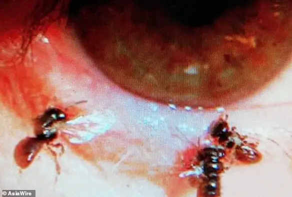 MEDICINA ONLINE Medico trova quattro api nell'occhio di una donna Sono vive grazie alle lacrime.jpg
