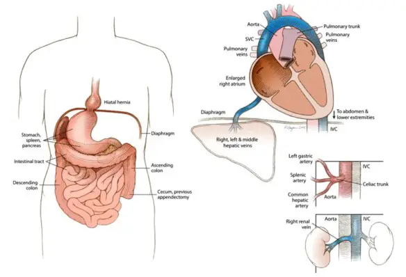 MEDICINA ONLINE Rose Marie Bentley Donna passa intera vita con gli organi del corpo al contrario muore senza averlo mai scoperto 2.jpg