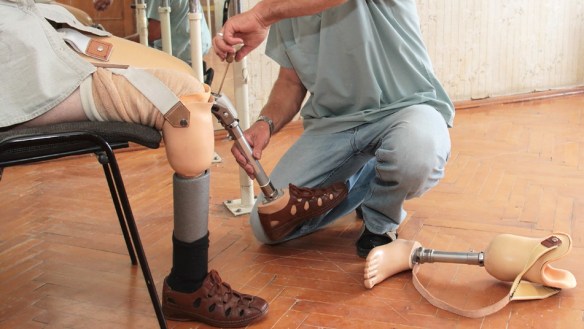 MEDICINA ONLINE AMPUTAZIONE MONCONE  PROTESI RIABILITAZIONE ENTRAMBE GAMBE.jpg