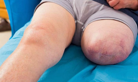 MEDICINA ONLINE AMPUTAZIONE MONCONE PROTESI RIABILITAZIONE GAMBA