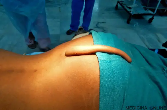 MEDICINA ONLINE Anche gli esseri umani possono avere una coda Hanuman cisti malformazione colonna vertebrale appendice gemello evanescente parassita schiena ano.jpg
