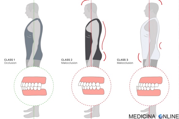 MEDICINA ONLINE Malocclusione dentale di 1° 2° e 3° grado cause sintomi diagnosi cure mandibola storta sporgente piccola indietro mascella denti masticazione postura.jpg
