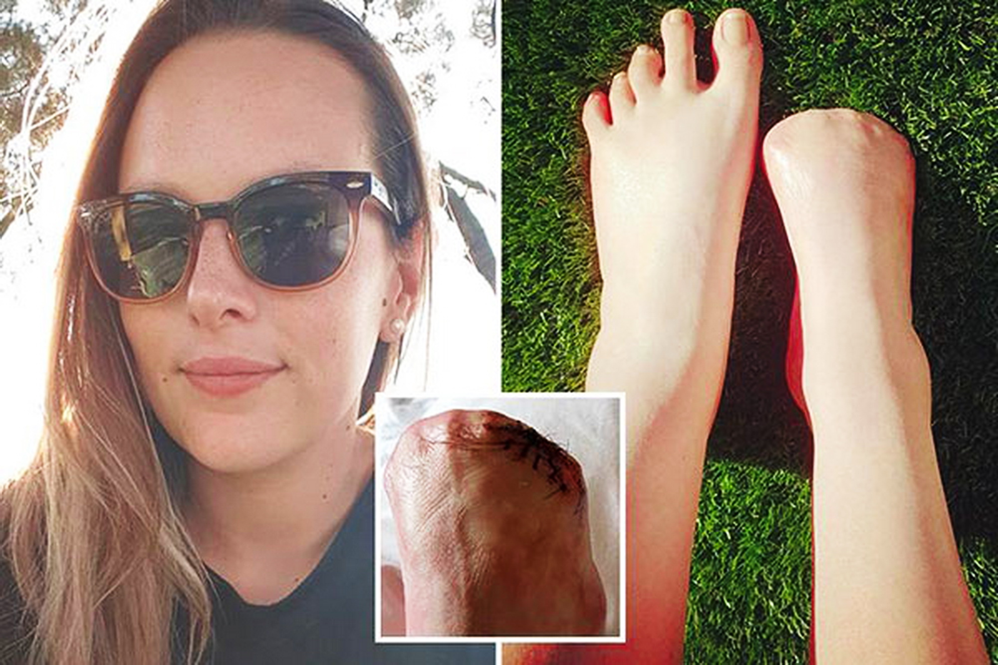 MEDICINA ONLINE Victoria Curthoys Fa una pedicure con i pesci, ragazza costretta ad amputare quattro dita del piede.jpg