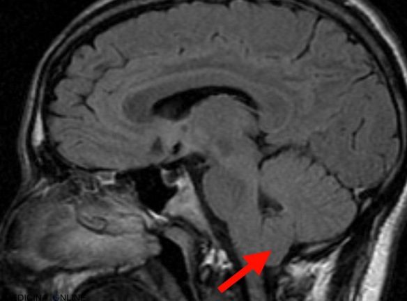 MEDICINA ONLINE SINDROME DI ARNOLD CHIARI ERNIAZIONE DELLE TONSILLE CEREBELLARI CERVELLETTO MALFORMAZIONE RISONANZA MAGNETICA LINGUAGGIO SI MUORE MORTE MORTALITA ASPETTATIVE DI VITA INVALIDITA.jpg
