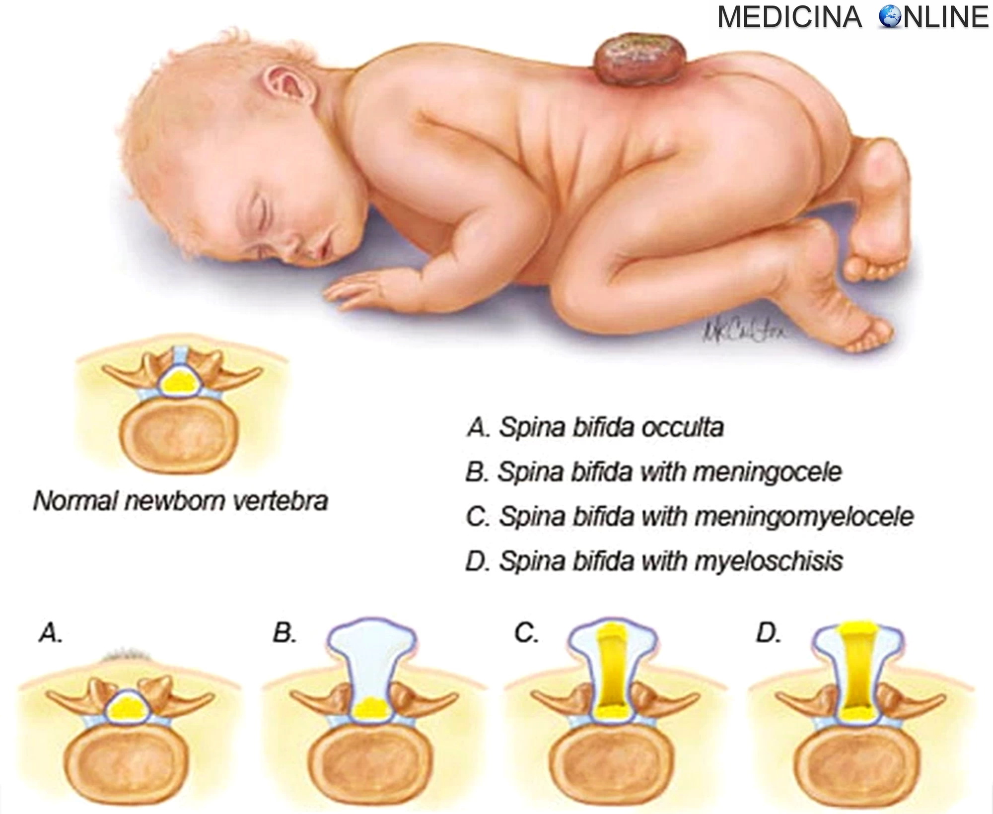 MEDICINA ONLINE SPINA BIFIDA NEONATO TIPI VERTEBRE COLONNA VERTEBRALE MIDOLLO SPINALE MENINGI MENINGOCELE MIELOMENINGOCELE MIELOSCHISI OCCULTA DIFFERENZE