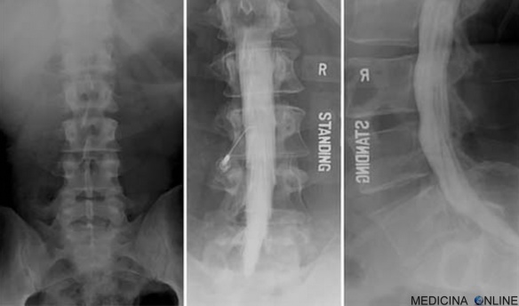 MEDICINA ONLINE MIELOGRAFIA MIELOGRAMMA RADIOGRAFIA DEL MIDOLLO SPINALE MEZZO DI CONTRASTO PROCEDURA TECNICA PUNTURA LOMBARE LIQUOR LIQUIDO CEFALO RACHIDIANO SCHIENA DOLORE.jpg