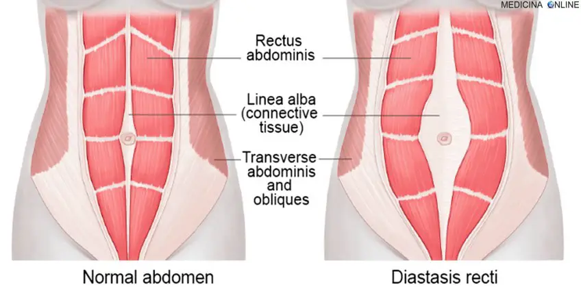 MEDICINA ONLINE DIASTASIS RECTI ABDOMEN ABDOMINAL DIASTASI ADDOMINALE DEI MUSCOLI RETTI ADDOMINALI GRAVIDANZA PARTO INCINTA FETO NEONATO ADDOME ADDOMINOPLASTICA