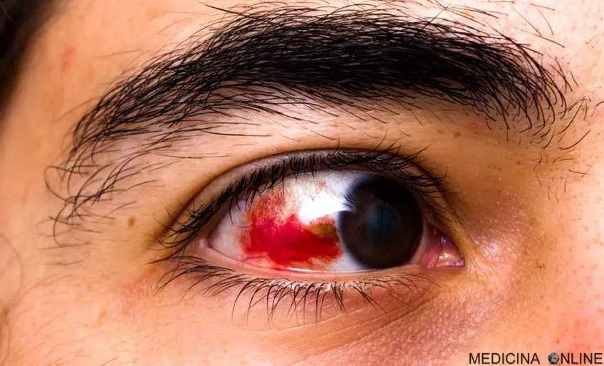 MEDICINA ONLINE MACCHIA PUNTINO SANGUE ROSSA ROSSO VIVO IN OCCHIO COSA FARE RIMEDI DEVO PREOCCUPARVI VADO MEDICO SCLERA BIANCO NON VEDO IFEMA EMORRAGIA SOTTOCONGIUNTIVALE IPOSFAGMA