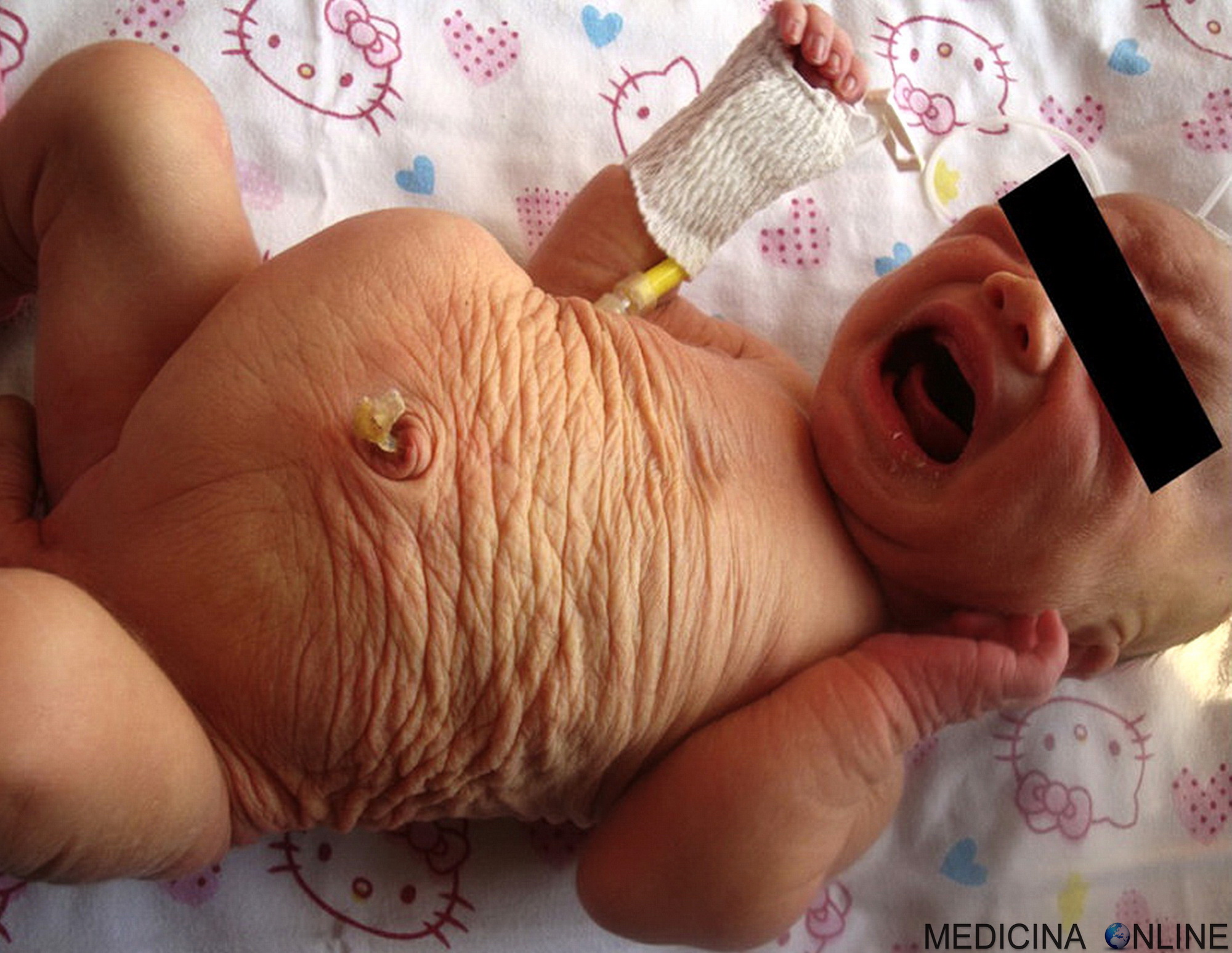MEDICINA ONLINE SINDROME ADDOME A PRUGNA SECCA ITALIANO PANCIA NEONATO PRUNE BELLY SYNDROME OBRINSKY EAGLE BARRET MALATTIA GENETICA