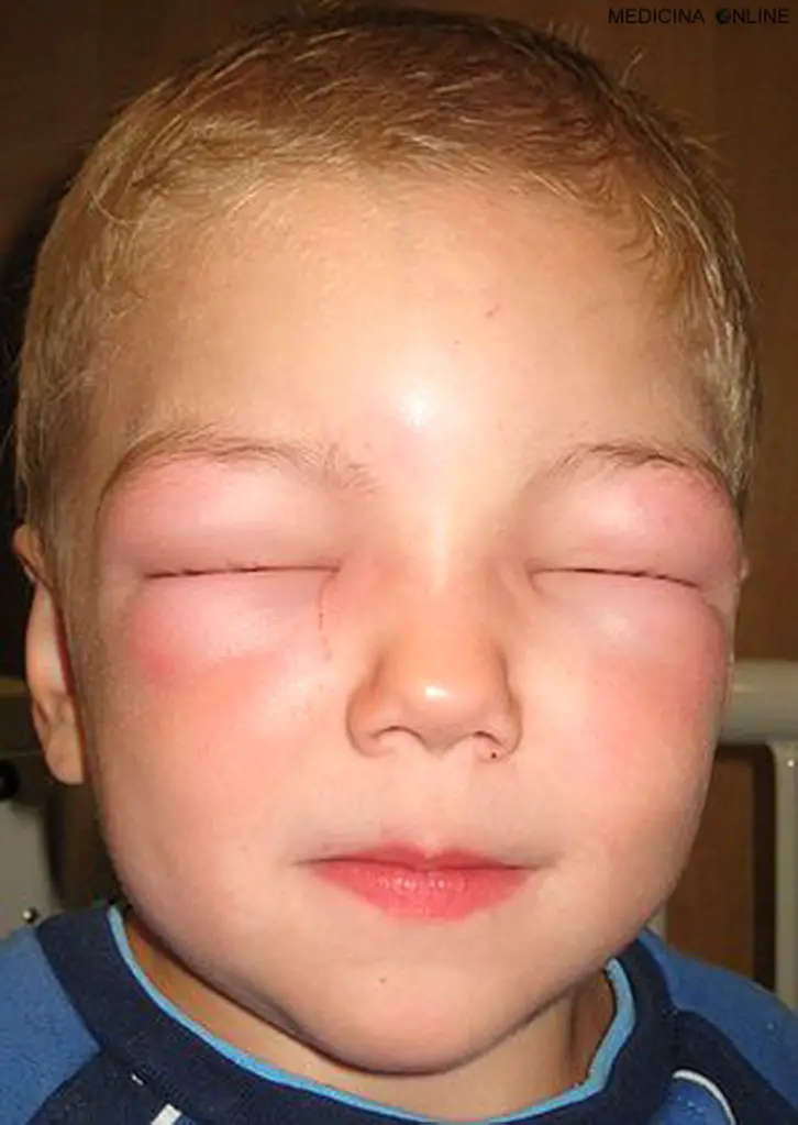 MEDICINA ONLINE ANGIOEDEMA ALLERGIA ORTICARIA