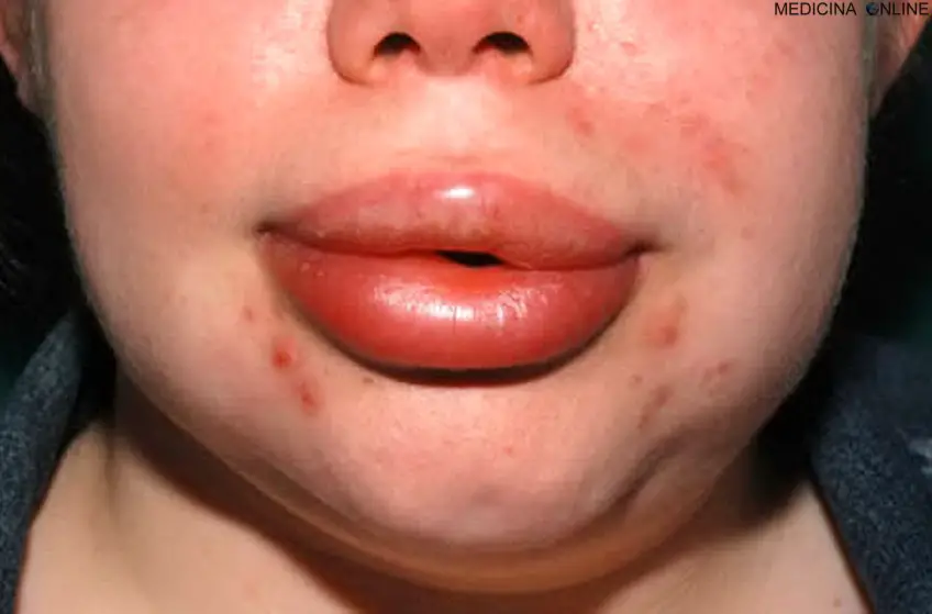 MEDICINA ONLINE ANGIOEDEMA ALLERGIA ORTICARIA