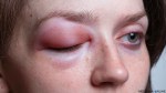 MEDICINA ONLINE ANGIOEDEMA ALLERGIA ORTICARIA