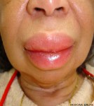 MEDICINA ONLINE ANGIOEDEMA ALLERGIA ORTICARIA