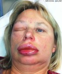 MEDICINA ONLINE ANGIOEDEMA ALLERGIA ORTICARIA