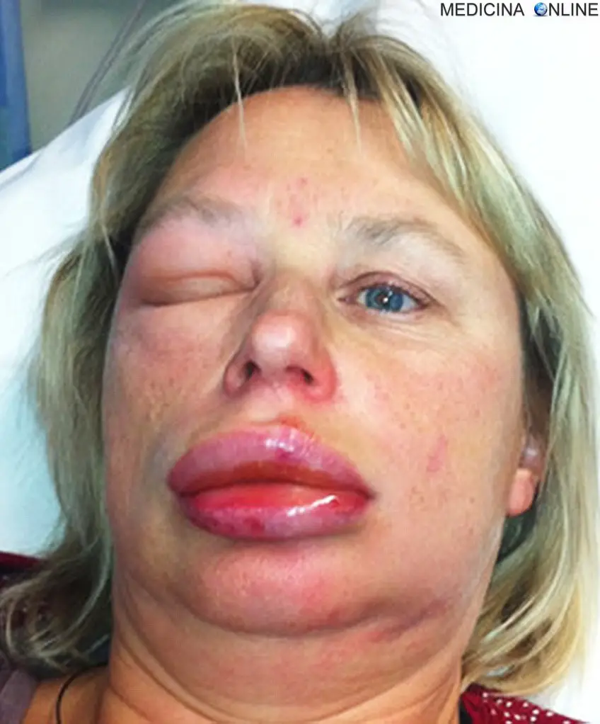 MEDICINA ONLINE ANGIOEDEMA ALLERGIA ORTICARIA